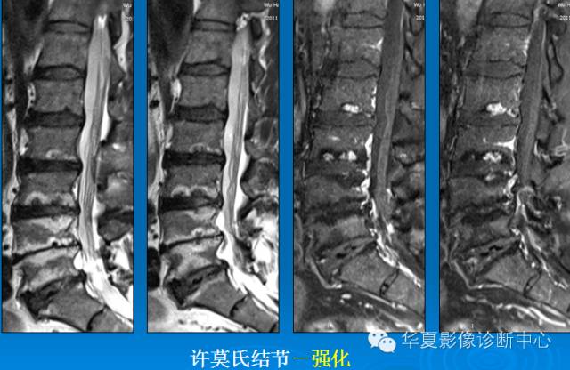 【PPT】椎间盘退变某些MR征象再认识