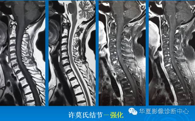 【PPT】椎间盘退变某些MR征象再认识