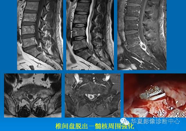 【PPT】椎间盘退变某些MR征象再认识