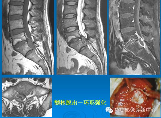 【PPT】椎间盘退变某些MR征象再认识