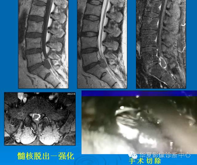 【PPT】椎间盘退变某些MR征象再认识