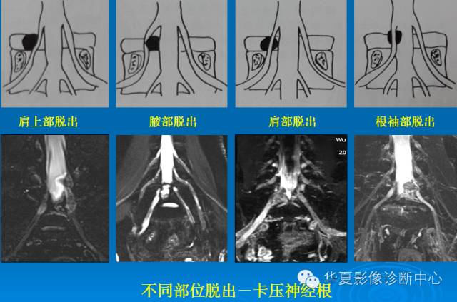 【PPT】椎间盘退变某些MR征象再认识