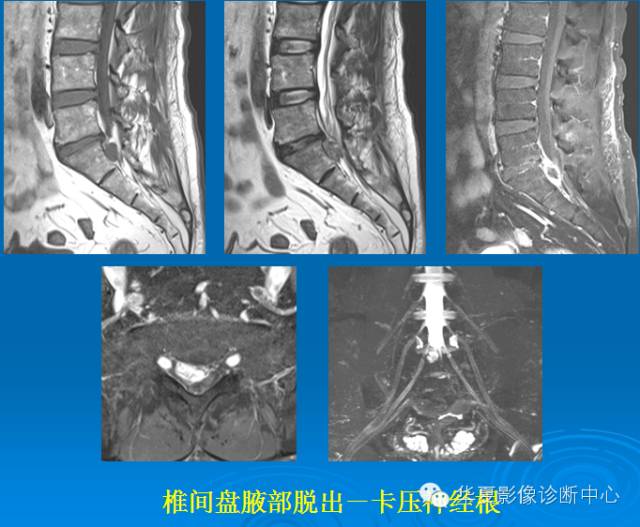 【PPT】椎间盘退变某些MR征象再认识