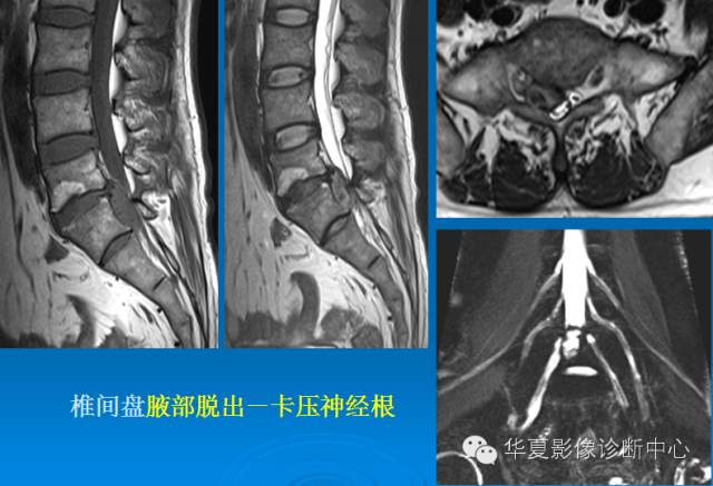 【PPT】椎间盘退变某些MR征象再认识