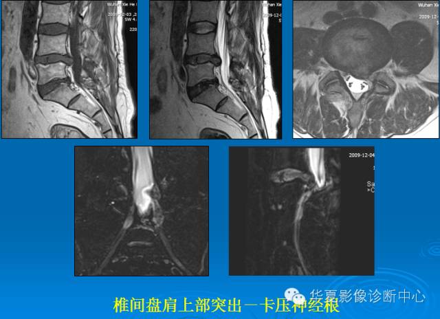 【PPT】椎间盘退变某些MR征象再认识