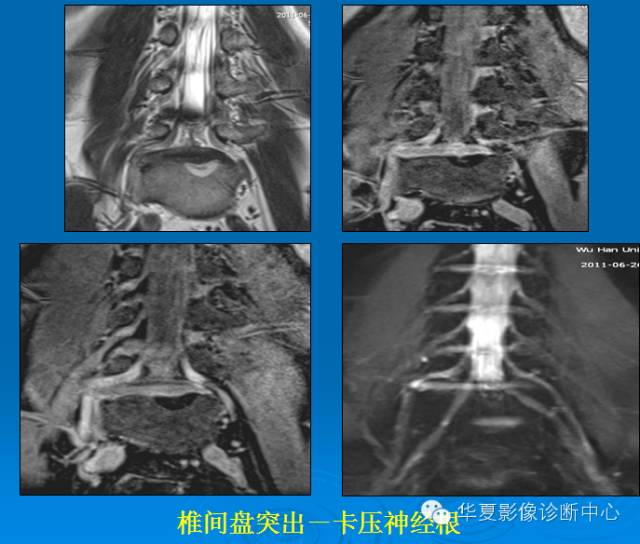 【PPT】椎间盘退变某些MR征象再认识