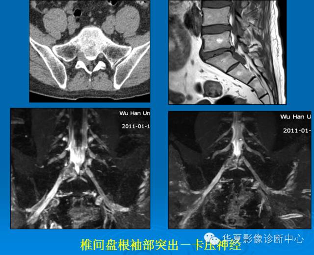 【PPT】椎间盘退变某些MR征象再认识