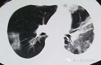 【病例】慢性嗜酸细胞性肺炎1例CT影像表现 【病例】慢性嗜酸细胞性肺炎1例CT影像表现