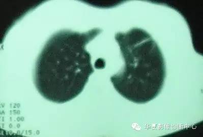 【病例】慢性嗜酸细胞性肺炎1例CT影像表现 【病例】慢性嗜酸细胞性肺炎1例CT影像表现