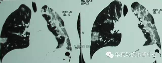 【病例】慢性嗜酸细胞性肺炎1例CT影像表现 【病例】慢性嗜酸细胞性肺炎1例CT影像表现