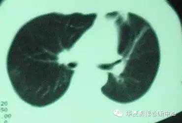 【病例】慢性嗜酸细胞性肺炎1例CT影像表现 【病例】慢性嗜酸细胞性肺炎1例CT影像表现