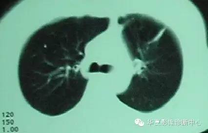 【病例】慢性嗜酸细胞性肺炎1例CT影像表现 【病例】慢性嗜酸细胞性肺炎1例CT影像表现