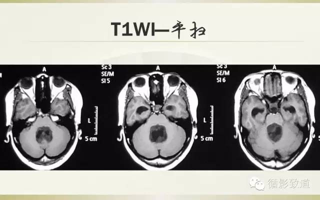 【病例】四脑室菊形团形成性胶质神经元肿瘤RGNT1例