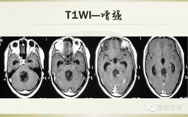 【病例】四脑室菊形团形成性胶质神经元肿瘤RGNT1例