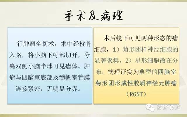 【病例】四脑室菊形团形成性胶质神经元肿瘤RGNT1例