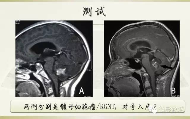 【病例】四脑室菊形团形成性胶质神经元肿瘤RGNT1例