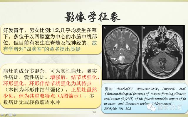 【病例】四脑室菊形团形成性胶质神经元肿瘤RGNT1例