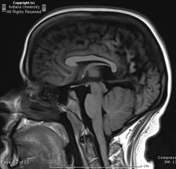 【病例】Chiari II畸形1例MR影像表现