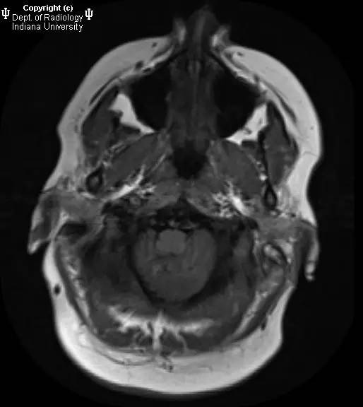 【病例】Chiari II畸形1例MR影像表现 【病例】Chiari II畸形1例MR影像表现