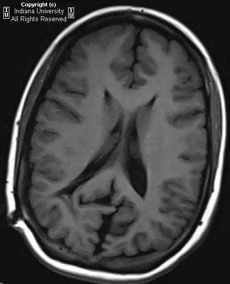 【病例】Chiari II畸形1例MR影像表现 【病例】Chiari II畸形1例MR影像表现
