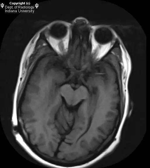 【病例】Chiari II畸形1例MR影像表现 【病例】Chiari II畸形1例MR影像表现
