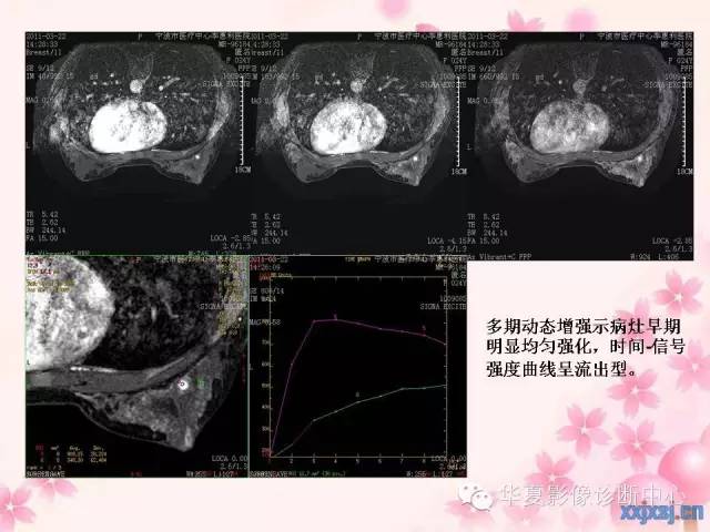【PPT】乳腺MRI对直径1厘米左右小结节灶良恶性的界定作用