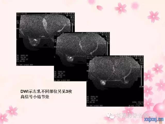 【PPT】乳腺MRI对直径1厘米左右小结节灶良恶性的界定作用