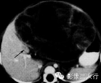 小儿肝脏肿瘤的鉴别诊断 小儿肝脏肿瘤的鉴别诊断