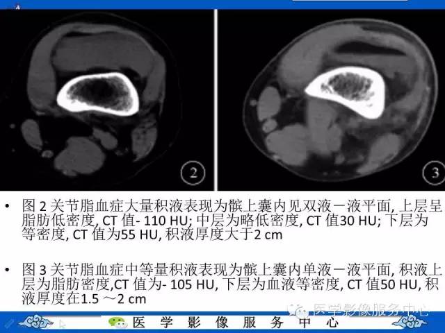 【影像征象】FBI征——脂一液平面征