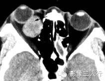 5种眶内肿瘤的鉴别诊断