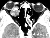 5种眶内肿瘤的鉴别诊断