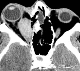 5种眶内肿瘤的鉴别诊断