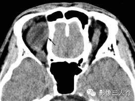 5种眶内肿瘤的鉴别诊断