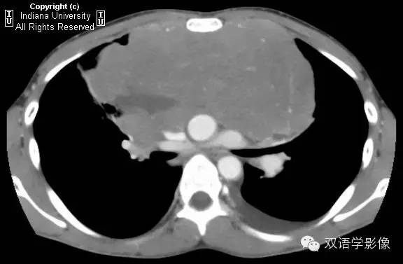 【双语病例】纵隔淋巴瘤1例CT影像表现 【双语病例】纵隔淋巴瘤1例CT影像表现
