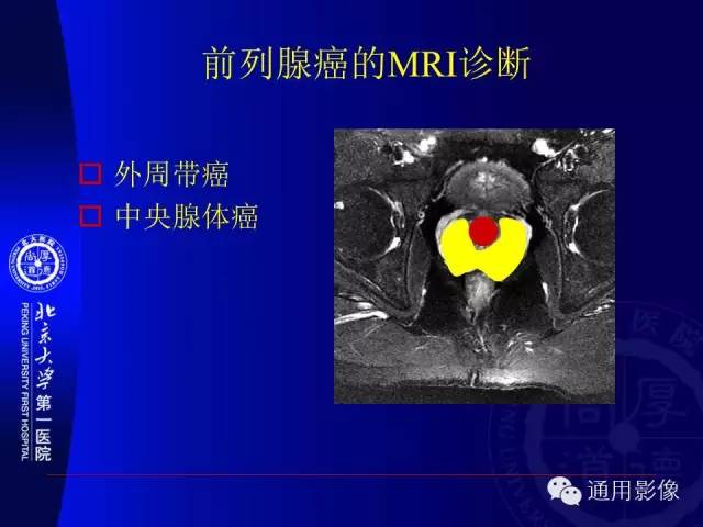 【PPT】前列腺癌的MRI诊断及进展