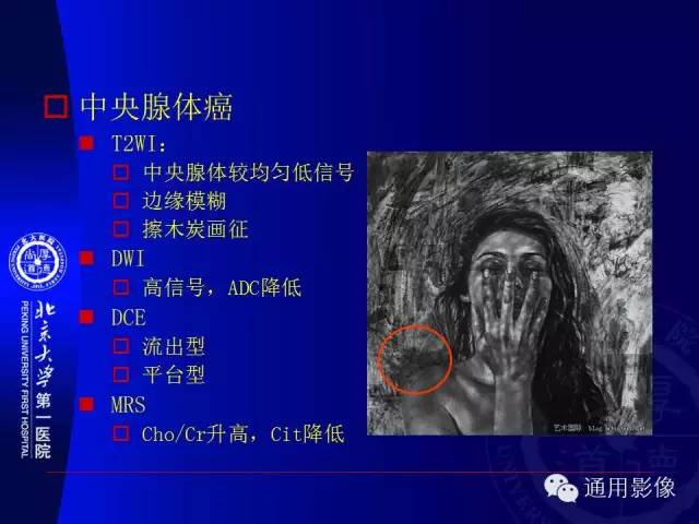 【PPT】前列腺癌的MRI诊断及进展