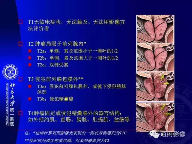 【PPT】前列腺癌的MRI诊断及进展