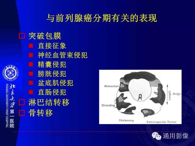 【PPT】前列腺癌的MRI诊断及进展