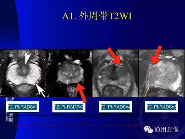 【PPT】前列腺癌的MRI诊断及进展