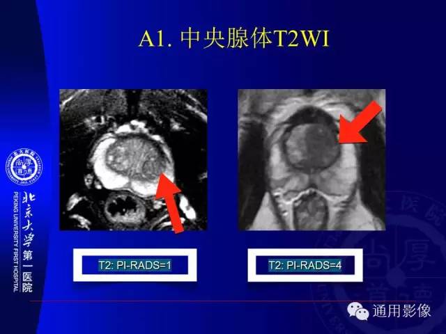 【PPT】前列腺癌的MRI诊断及进展