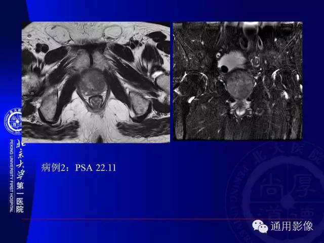 【PPT】前列腺癌的MRI诊断及进展