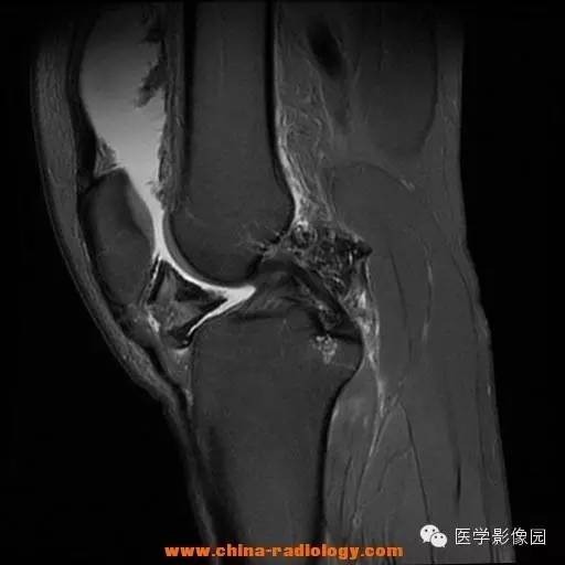 【病例】色素沉着绒毛结节性滑膜炎1例MR影像表现 【病例】色素沉着绒毛结节性滑膜炎1例MR影像表现