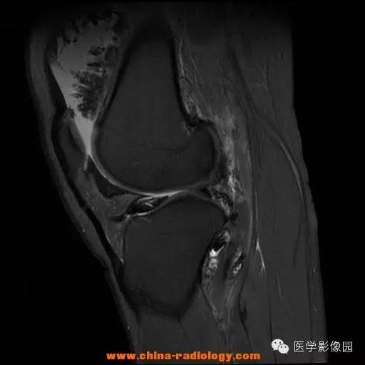 【病例】色素沉着绒毛结节性滑膜炎1例MR影像表现