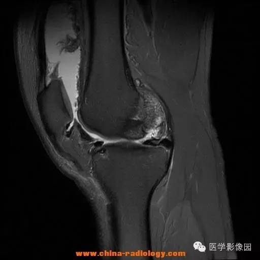 【病例】色素沉着绒毛结节性滑膜炎1例MR影像表现 【病例】色素沉着绒毛结节性滑膜炎1例MR影像表现