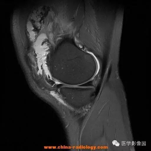 【病例】色素沉着绒毛结节性滑膜炎1例MR影像表现 【病例】色素沉着绒毛结节性滑膜炎1例MR影像表现