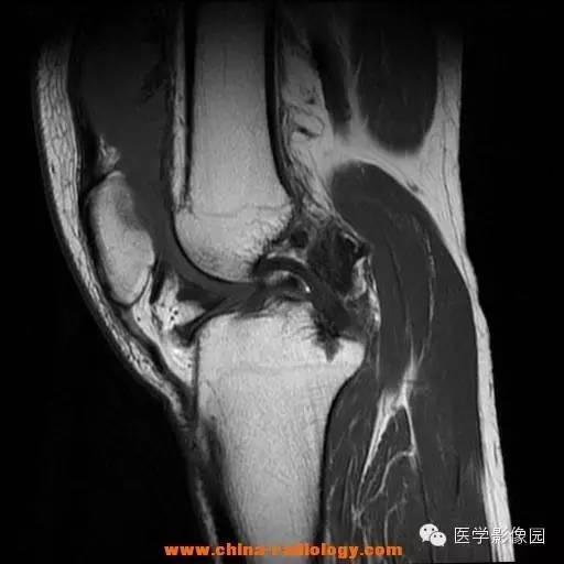 【病例】色素沉着绒毛结节性滑膜炎1例MR影像表现 【病例】色素沉着绒毛结节性滑膜炎1例MR影像表现