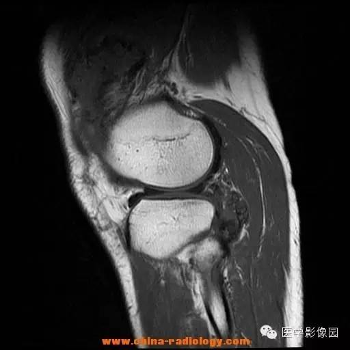 【病例】色素沉着绒毛结节性滑膜炎1例MR影像表现 【病例】色素沉着绒毛结节性滑膜炎1例MR影像表现