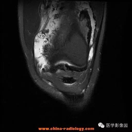 【病例】色素沉着绒毛结节性滑膜炎1例MR影像表现 【病例】色素沉着绒毛结节性滑膜炎1例MR影像表现