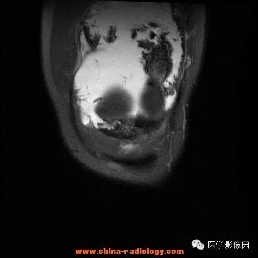 【病例】色素沉着绒毛结节性滑膜炎1例MR影像表现 【病例】色素沉着绒毛结节性滑膜炎1例MR影像表现