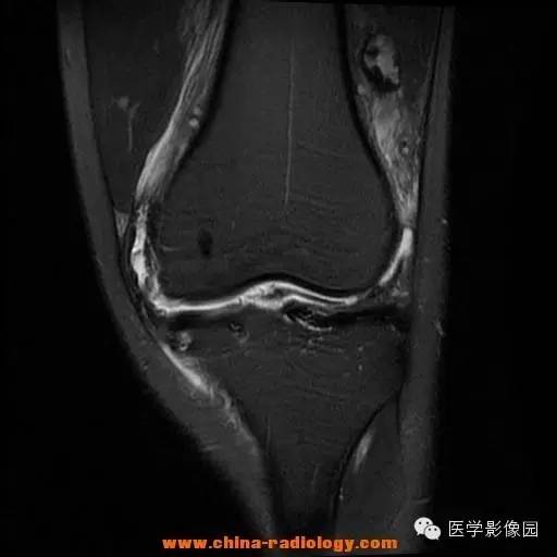 【病例】色素沉着绒毛结节性滑膜炎1例MR影像表现 【病例】色素沉着绒毛结节性滑膜炎1例MR影像表现